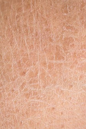 closeup of dry skin